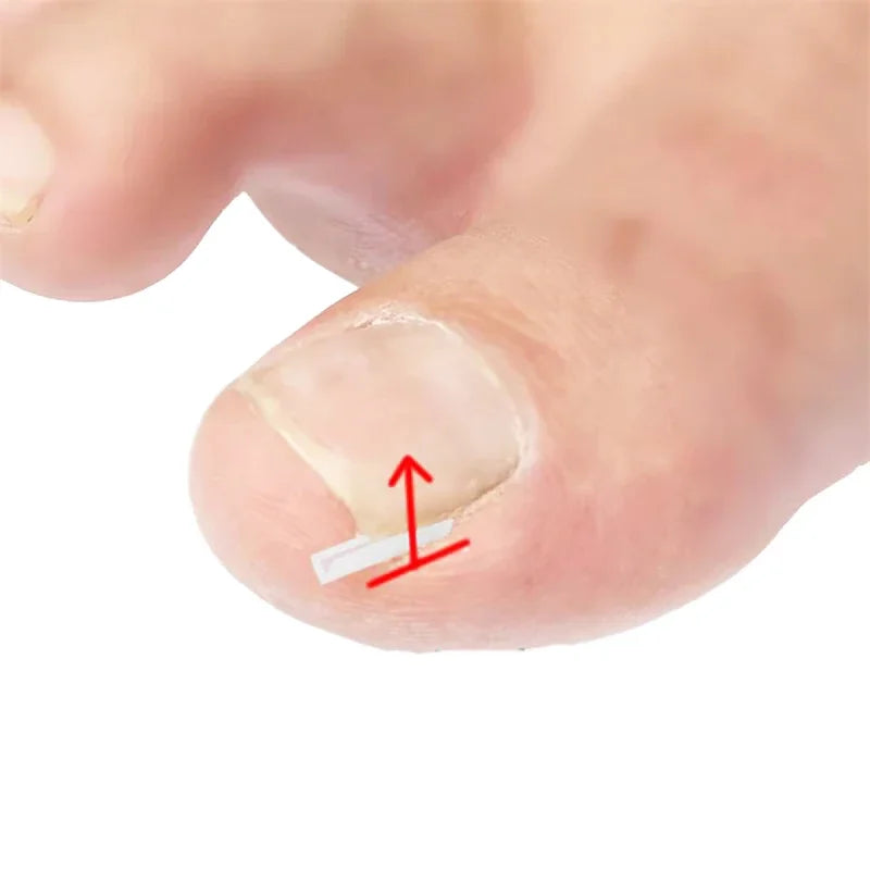 50Pcs Elastic Patch Sticker Pedicure Tool Ingrown Toenail Correction