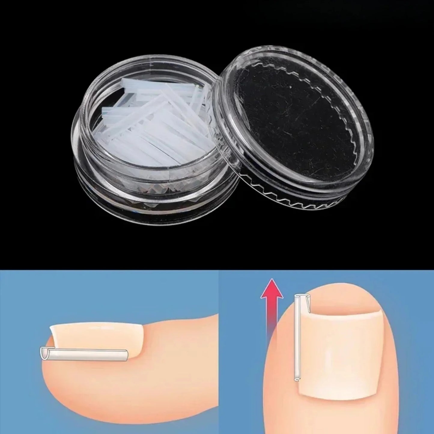 50Pcs Ingrown Toenail Correction Tool Ingrown Toe Nail Treatment