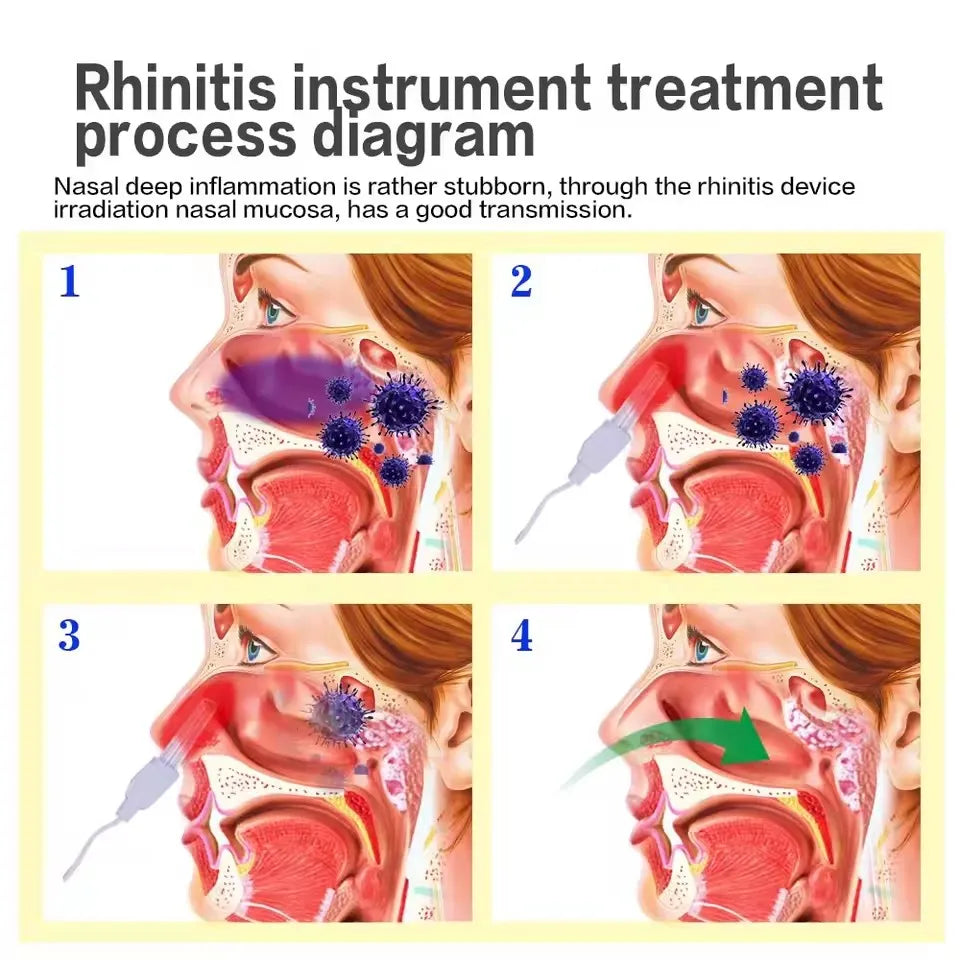Nose Rhinitis Sinusitis Cure BioNase Laser Therapy Hay Fever Low