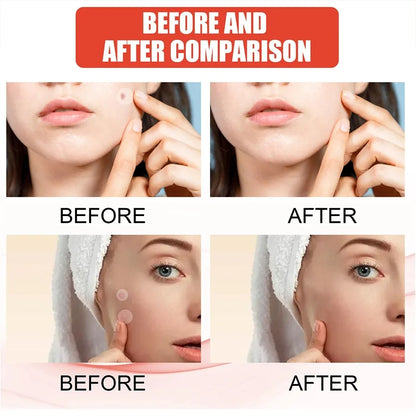 144pcs Face Acne Patch Invisible Skin Care Pimple Acne Patches