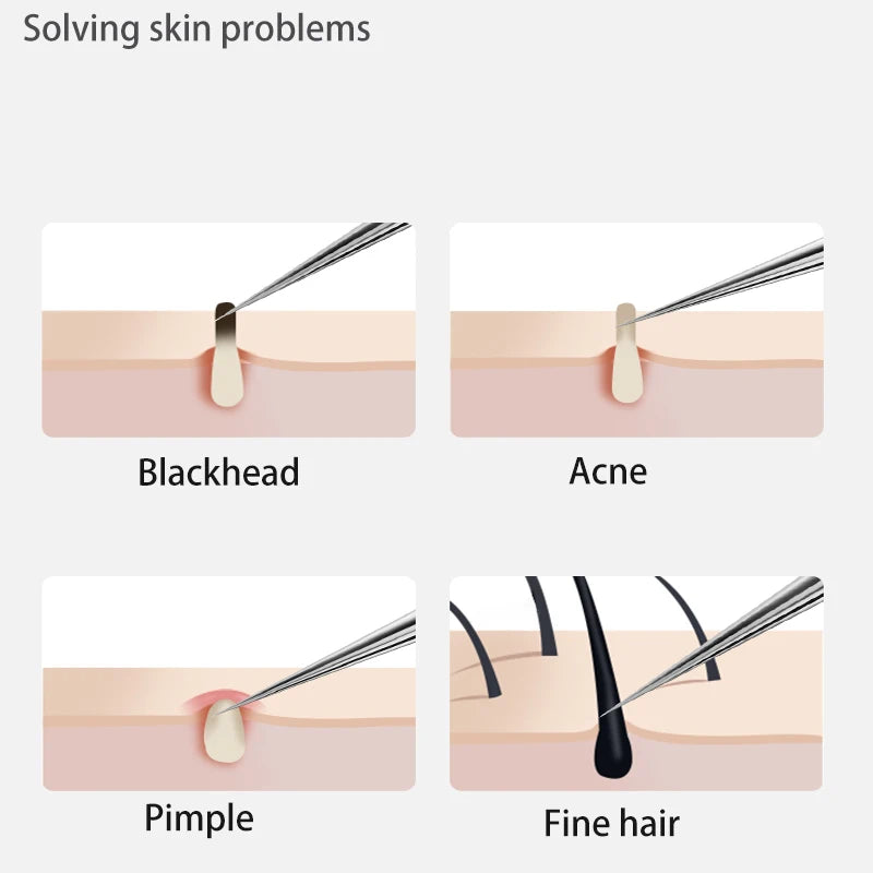 Acne Blackhead Removal Needles Stainless Steel Black Spot Blemish