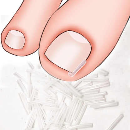 50Pcs/Box Ingrown Toenail Correction Strips Paronychia Correction