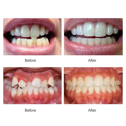 Dental Accessories 3 Stages Dental Braces Teeth Trainer Alignment