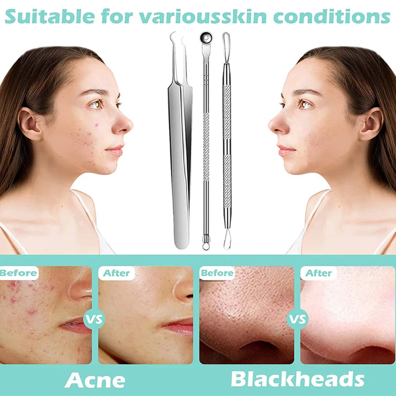 Acne Blackhead Removal Needles Stainless Steel Black Spot Blemish