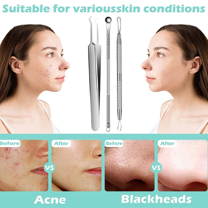 Acne Blackhead Removal Needles Stainless Steel Black Spot Blemish